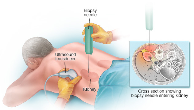 Percutaneous Biopsy and Drainages